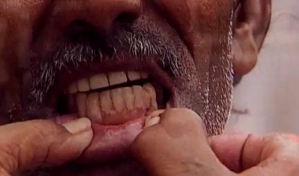 インドの路上歯医者