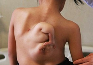 背中に「もう一人の自分」が張り付いている11歳の少女、切除手術へ