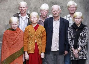 インド人だけど全員真っ白。デリーのアルビノ家族がギネス記録達成