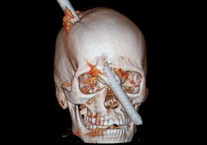 金属棒が頭部を貫通
