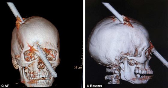 金属棒が頭部貫通
